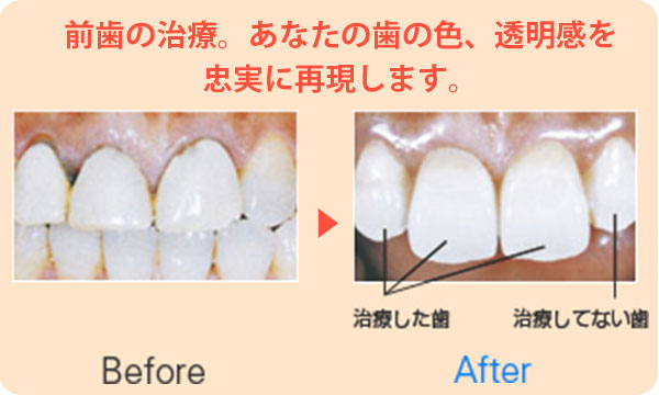 ホワイトニング | 阿佐ヶ谷／南阿佐ヶ谷のなぎさデンタルクリニック